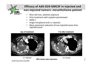 Efficacy of Ad5‐D24‐GMCSF in injected and 
                     non injected tumors: mesothelioma patient
                     non‐injected tumors: mesothelioma patient
                          •        60 yr old man, asbestos exposure
                          •        Prior treatment with cisplatin+pemetrexed
                                   Prior treatment with cisplatin+pemetrexed
                          •        WHO 1
                          •        Single intrapleural and i.v. injection 
                          •        More prominent reduction of non‐injected tumor than 
                                   More prominent reduction of non injected tumor than
                                   injected tumor




                                                                       A k s e l i   H e m m i n k i       |     2 3  F e b  2 0 1 0    |    2 6
Cerullo Cancer Res in press 2010
 