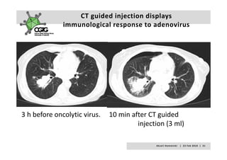 CT guided injection displays 
              immunological response to adenovirus
              immunological response to adenovirus




3 h before oncolytic virus.     10 min after CT guided 
3 h before oncolytic virus. 10 min after CT guided
                                         injection (3 ml)

                                               A k s e l i   H e m m i n k i       |     2 3  F e b  2 0 1 0    |    3 1
 