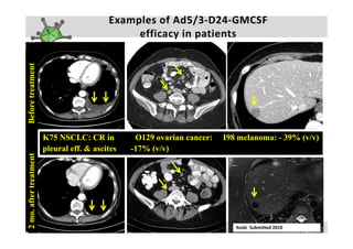 Examples of Ad5/3‐D24‐GMCSF 
              nt
Before treatmen
       t                                        efficacy in patients




                        K75 NSCLC: CR in          O129 ovarian cancer:   I98 melanoma: - 39% (v/v)
                        p
                        pleural eff. & ascites   -17% (v/v)
                                                      (v/v)
                                                          )
              eatment
2 mo. after tre




                                                                            Koski  Submitted 2010    2 3  F e b  2 0 1 0    |    4 5
                                                                               Akseli Hemminki   |
 