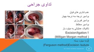 ‫فوق‬ ‫های‬ ‫تداوی‬ ‫عدم‬
‫چهار‬ ‫درجه‬ ‫سه‬ ‫درجه‬ ‫بواسیر‬
‫فبروزی‬ ‫بواسیر‬
‫مختلط‬ ‫بواسیر‬
‫باز‬ ‫میتود‬ ‫به‬ ‫عملیاتی‬ ‫تکنیک‬
Excision/ligation:1
((Milligan Morgan method
:2‫بسته‬ ‫میتود‬ ‫به‬
(Ferguson method)Excision /suture
‫جراحی‬ ‫تداوی‬
D R H A M I D R A H M A N S A B A W O O N 23
 