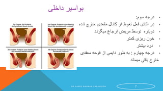 ‫داخلی‬ ‫بواسیر‬
•‫سوم‬ ‫درجه‬:
•‫شده‬ ‫خارج‬ ‫مقعدی‬ ‫کانال‬ ‫از‬ ‫تغوط‬ ‫فعل‬ ‫اثنای‬ ‫در‬
•‫میگردد‬ ‫ارجاع‬ ‫مریض‬ ‫توسط‬ ‫دوباره‬
•‫کمتر‬ ‫ریزی‬ ‫خون‬
•‫بیشتر‬ ‫درد‬
•‫چهارم‬ ‫درجه‬:‫معقدی‬ ‫فوحه‬ ‫از‬ ‫دایمی‬ ‫طور‬ ‫به‬
‫میماند‬ ‫باقی‬ ‫خارج‬
D R H A M I D R A H M A N S A B A W O O N 7
 