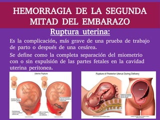 Hemorragia en el 2do Trimestre del Embarazo 