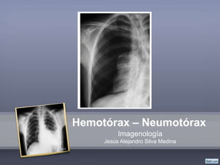 Hemotórax – Neumotórax
Imagenología
Jesús Alejandro Silva Medina
 