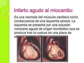 Infarto agudo al miocardio:
Es una necrosis del músculo cardiaco como
consecuencia de una isquemia severa. La
isquemia se presenta por una oclusión
coronaria aguda de origen trombótico que se
produce tras la ruptura de una placa de
ateroma vulnerable.
 