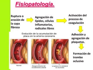 Fisiopatología.
Ruptura o
erosión de
la capa
fibrosa
Agregación de
lípidos, células
inflamatorias,
radicales libres.
Activación del
proceso de
coagulación
Adhesión y
agregación de
plaquetas.
Formación de
trombo
oclusivo
 