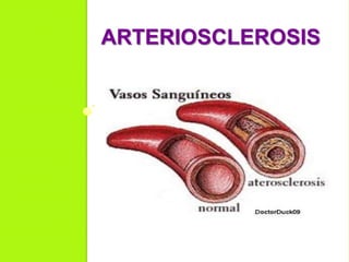 ARTERIOSCLEROSIS
 