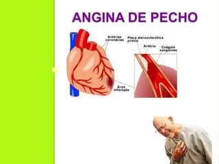 ANGINA DE PECHO
 