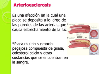 Arterioesclerosis
Es una afección en la cual una
placa se deposita a lo largo de
las paredes de las arterias que
causa estrechamiento de la luz.
*Placa es una sustancia
pegajosa compuesta de grasa,
colesterol calcio y otras
sustancias que se encuentran en
la sangre.
 