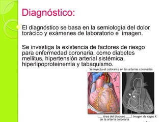 Diagnóstico:
El diagnóstico se basa en la semiología del dolor
torácico y exámenes de laboratorio e imagen.
Se investiga la existencia de factores de riesgo
para enfermedad coronaria, como diabetes
mellitus, hipertensión arterial sistémica,
hiperlipoproteinemia y tabaquismo.
 
