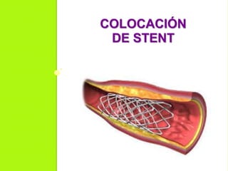 COLOCACIÓN
DE STENT
 