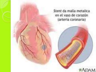 Patologías que requieren estudio de hemodinamia. 