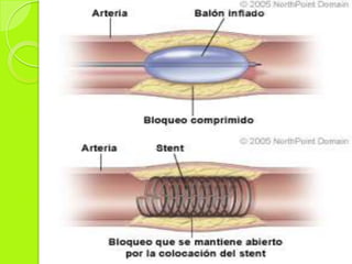 Patologías que requieren estudio de hemodinamia. 