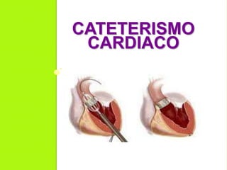 CATETERISMO
CARDIACO
 