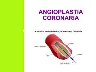 ANGIOPLASTIA
CORONARIA
 