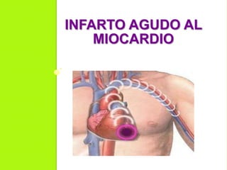 INFARTO AGUDO AL
MIOCARDIO
 