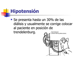 Hipotensión
   Se presenta hasta un 30% de las
    diálisis y usualmente se corrige colocar
    al paciente en posición de
    trendelenburg.
 