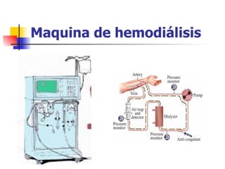 Maquina de hemodiálisis
 