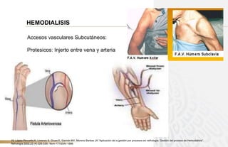 HEMODIALISIS
Accesos vasculares Subcutáneos:
Protesicos: Injerto entre vena y arteria
10. López-Revuelta K, Lorenzo S, Gruss E, Garrido MV, Moreno Barbas JA.”Aplicación de la gestión por procesos en nefrología. Gestión del proceso de Hemodiálisis”.
Nefrología 2002,22 (4):329-339) Nom-171SSAI-1998-
 