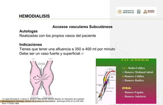HEMODIALISIS
Accesos vasculares Subcutáneos
Autologas
Realizadas con los propios vasos del paciente
Indicaciones
Tienes que tener una afluencia a 350 a 400 ml por minuto
Debe ser un vaso fuerte y superficial.12
12 López-Revuelta K, Lorenzo S, Gruss E, Garrido MV, Moreno Barbas JA.”Aplicación de la gestión
por procesos en nefrología. Gestión del proceso de Hemodiálisis”. Nefrología 2002,22 (4):329-339)
Nom-171SSAI-1998-
 