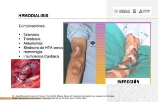 HEMODIALISIS
Complicaciones:
• Estenosis
• Trombosis
• Aneurismas
• Síndrome de HTA venosa
• Hemorragia
• Insuficiencia Cardiaca
14. López-Revuelta K, Lorenzo S, Gruss E, Garrido MV, Moreno Barbas JA.”Aplicación de la gestión por procesos en nefrología.
Gestión del proceso de Hemodiálisis”. Nefrología 2002,22 (4):329-339) Nom-171SSAI-1998-
 
