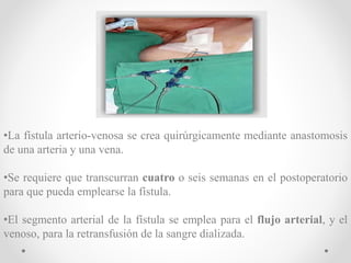 •La fístula arterio-venosa se crea quirúrgicamente mediante anastomosis
de una arteria y una vena.
•Se requiere que transcurran cuatro o seis semanas en el postoperatorio
para que pueda emplearse la fístula.
•El segmento arterial de la fístula se emplea para el flujo arterial, y el
venoso, para la retransfusión de la sangre dializada.
 
