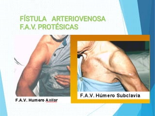FÍSTULA ARTERIOVENOSA
FÍSTULA ARTERIOVENOSA
F.A.V. PROTÉSICAS
F.A.V. PROTÉSICAS
 