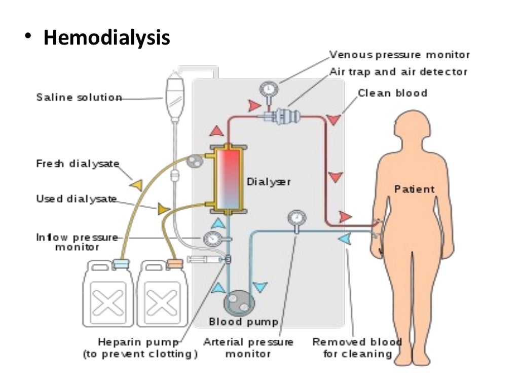 Hemodialysis,