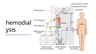 hemodial
ysis
 