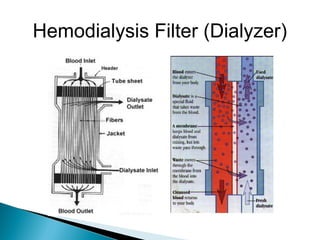 Hemodialysis Filter (Dialyzer)
 