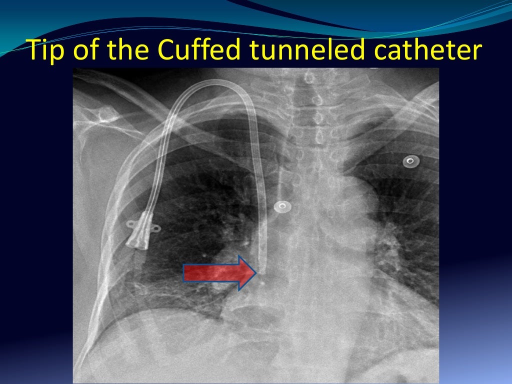 Hemodialysis vascular catheters review