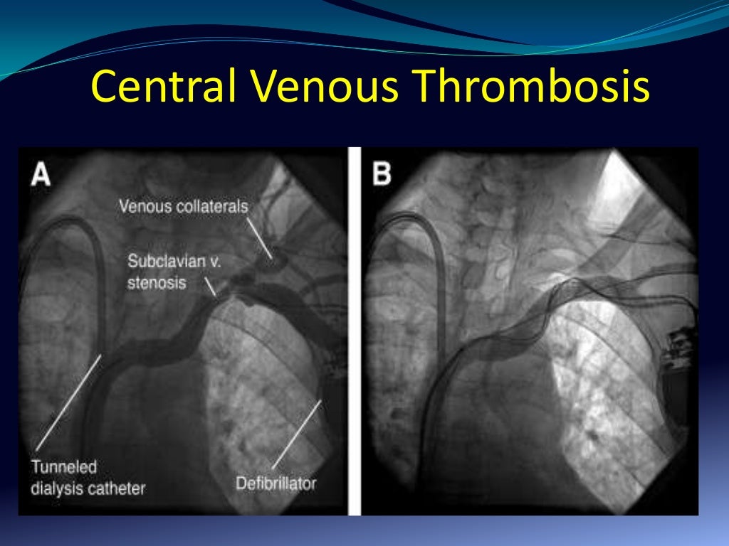Hemodialysis vascular catheters review