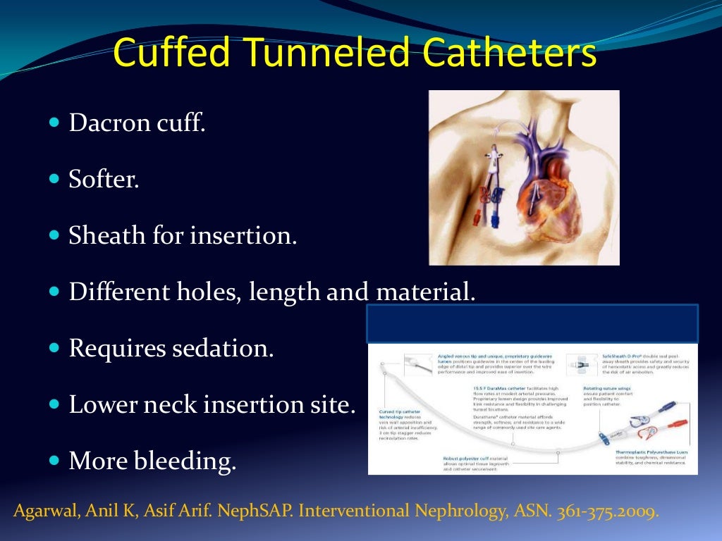 Hemodialysis vascular catheters review