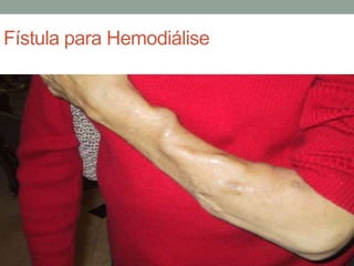 Fístula para Hemodiálise
 