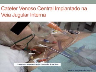 Cateter Venoso Central Implantado na
Veia Jugular Interna
 