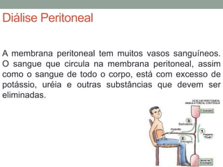 Diálise Peritoneal
A membrana peritoneal tem muitos vasos sanguíneos.
O sangue que circula na membrana peritoneal, assim
como o sangue de todo o corpo, está com excesso de
potássio, uréia e outras substâncias que devem ser
eliminadas.
 