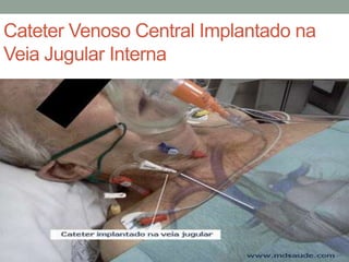 Cateter Venoso Central Implantado na
Veia Jugular Interna
 
