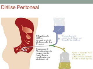 Diálise Peritoneal
 