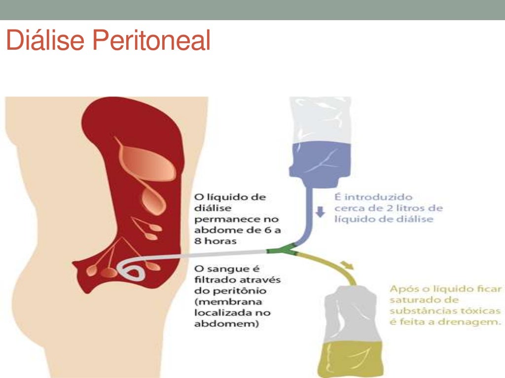 Hemodiálise e diálise peritoneal Hemodiálise e diálise peritoneal