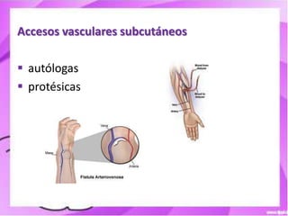 Accesos vasculares subcutáneos

 autólogas
 protésicas
 