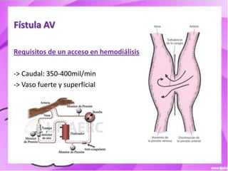 Fístula AV

Requisitos de un acceso en hemodiálisis

-> Caudal: 350-400mil/min
-> Vaso fuerte y superficial
 