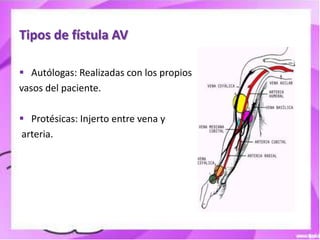 Tipos de fístula AV

 Autólogas: Realizadas con los propios
vasos del paciente.

 Protésicas: Injerto entre vena y
arteria.
 
