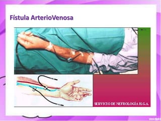 Fístula ArterioVenosa
 