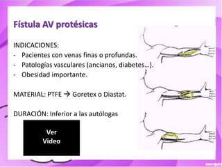Fístula AV protésicas

INDICACIONES:
- Pacientes con venas finas o profundas.
- Patologías vasculares (ancianos, diabetes…).
- Obesidad importante.

MATERIAL: PTFE  Goretex o Diastat.

DURACIÓN: Inferior a las autólogas

          Ver
         Video
 