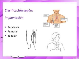 Clasificación según:

Implantación

 Subclavia
 Femoral
 Yugular
 