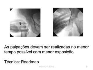 As palpações devem ser realizadas no menor
tempo possível com menor exposição.
Técnica: Roadmap
Antonio Carlos Moreira 32
 