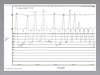 PCWP
Basal hemodynamik          19
 