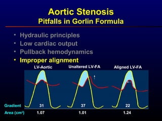 LV-Aortic Unaltered LV-FA Aligned LV-FA
Gradient
Area (cm2
)
31 37 22
1.07 1.01 1.24
• Hydraulic principles
• Low cardiac output
• Pullback hemodynamics
• Improper alignment
Aortic Stenosis
Pitfalls in Gorlin Formula
 