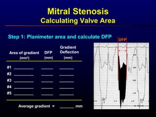 Mitral Stenosis
Calculating Valve Area
DFP
Step 1: Planimeter area and calculate DFP
Gradient
DeflectionDFPArea of gradient
(mm2
) (mm) (mm)
#1
#2
#3
#4
#5
Average gradient = mm
 
