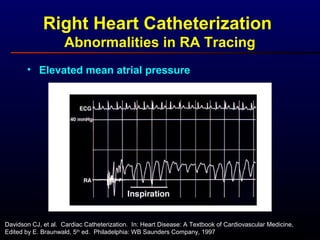 Right Heart Catheterization
Abnormalities in RA Tracing
• Elevated mean atrial pressure
Davidson CJ, et al. Cardiac Catheterization. In: Heart Disease: A Textbook of Cardiovascular Medicine,
Edited by E. Braunwald, 5th
ed. Philadelphia: WB Saunders Company, 1997
 