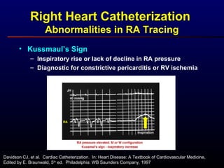 Right Heart Catheterization
Abnormalities in RA Tracing
• Kussmaul’s Sign
– Inspiratory rise or lack of decline in RA pressure
– Diagnostic for constrictive pericarditis or RV ischemia
Davidson CJ, et al. Cardiac Catheterization. In: Heart Disease: A Textbook of Cardiovascular Medicine,
Edited by E. Braunwald, 5th
ed. Philadelphia: WB Saunders Company, 1997
 